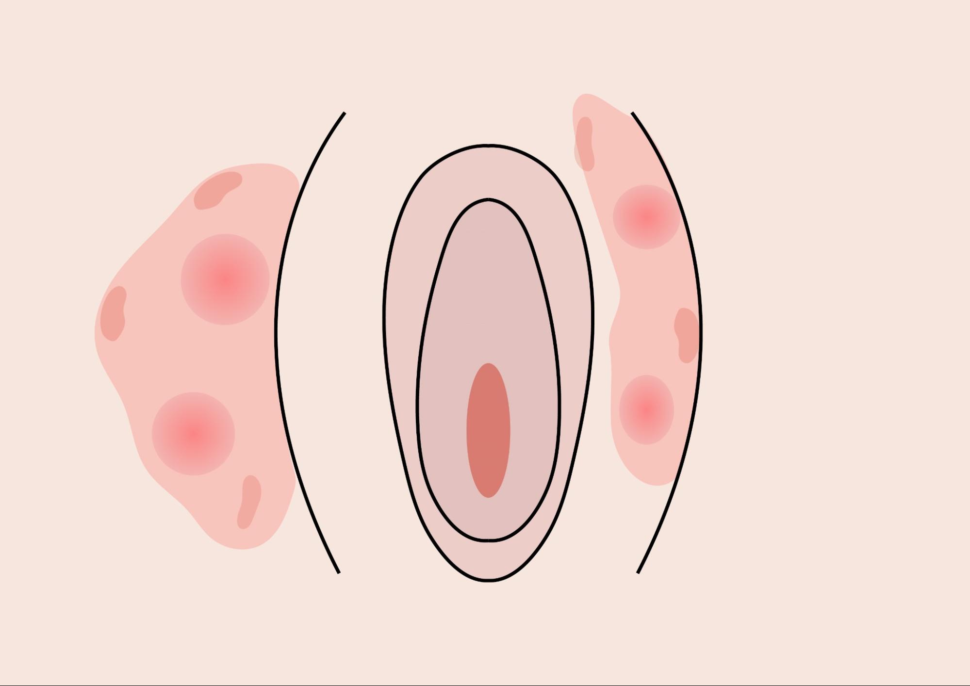 お股がかゆい原因と治し方｜カンジダやナプキンかぶれの真相と受診目安