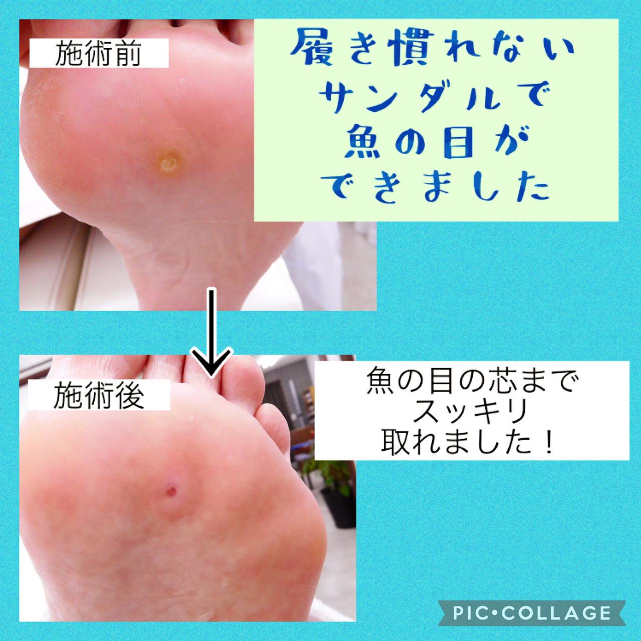 魚の目の取れた芯の画像と特徴を解説！穴の状態やイボとの違い完全版