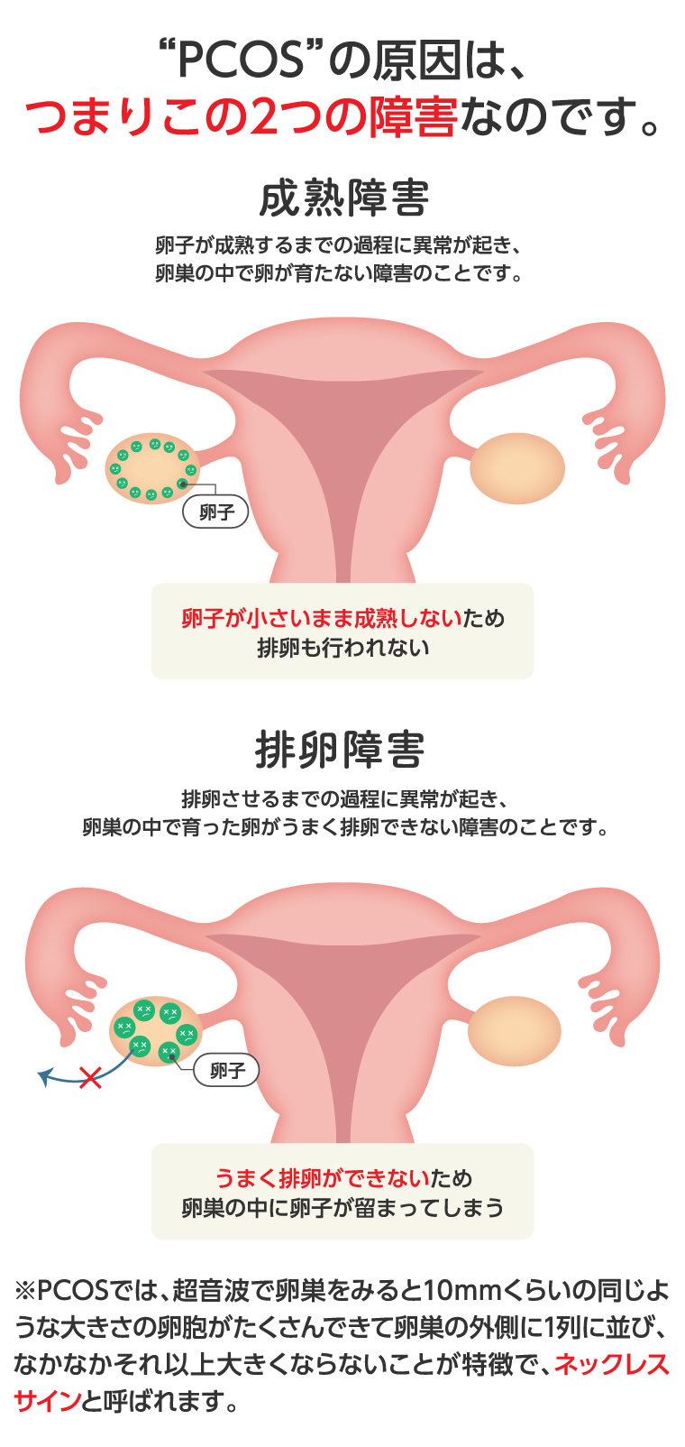 多嚢胞性卵巣症候群のサインと妊娠率｜不妊の不安を解消する最新治療法