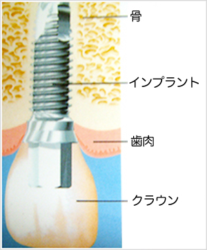 【Wiki風】 吉田正尚 歯 インプラント 徹底解説＆真相まとめ #621