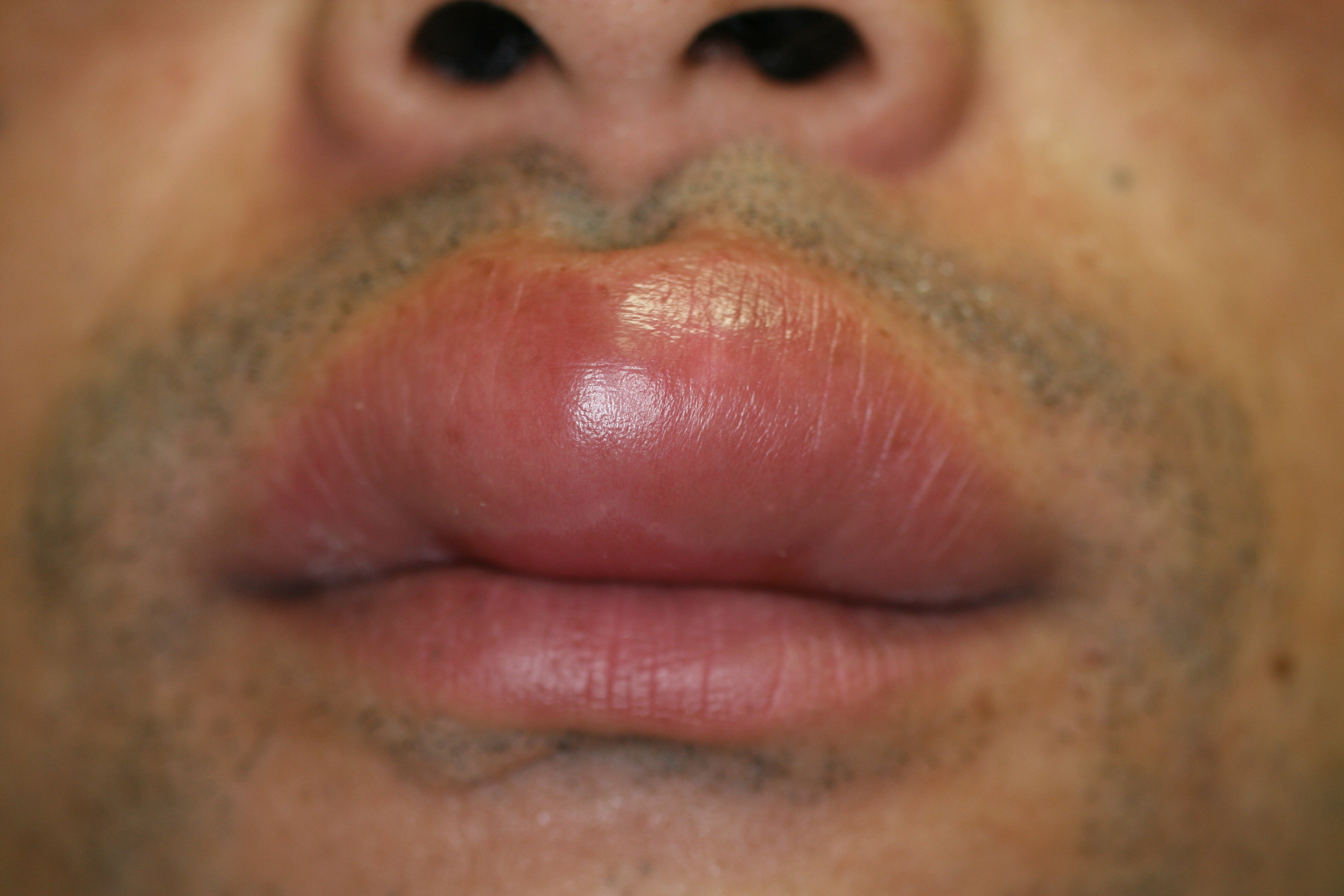 唇が突然腫れる蕁麻疹の正体は？クインケ浮腫と命に関わる危険サイン
