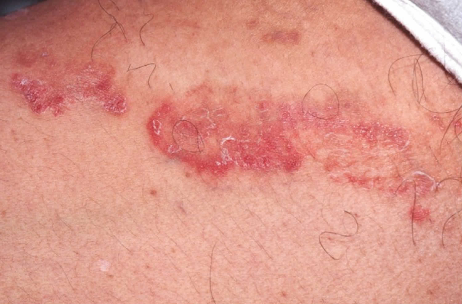 Fungal Infection on Buttocks Pictures