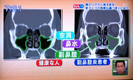 【真相】 好 酸 球 性 副 鼻腔 炎 芸能人 最新ニュース速報 2026 #701