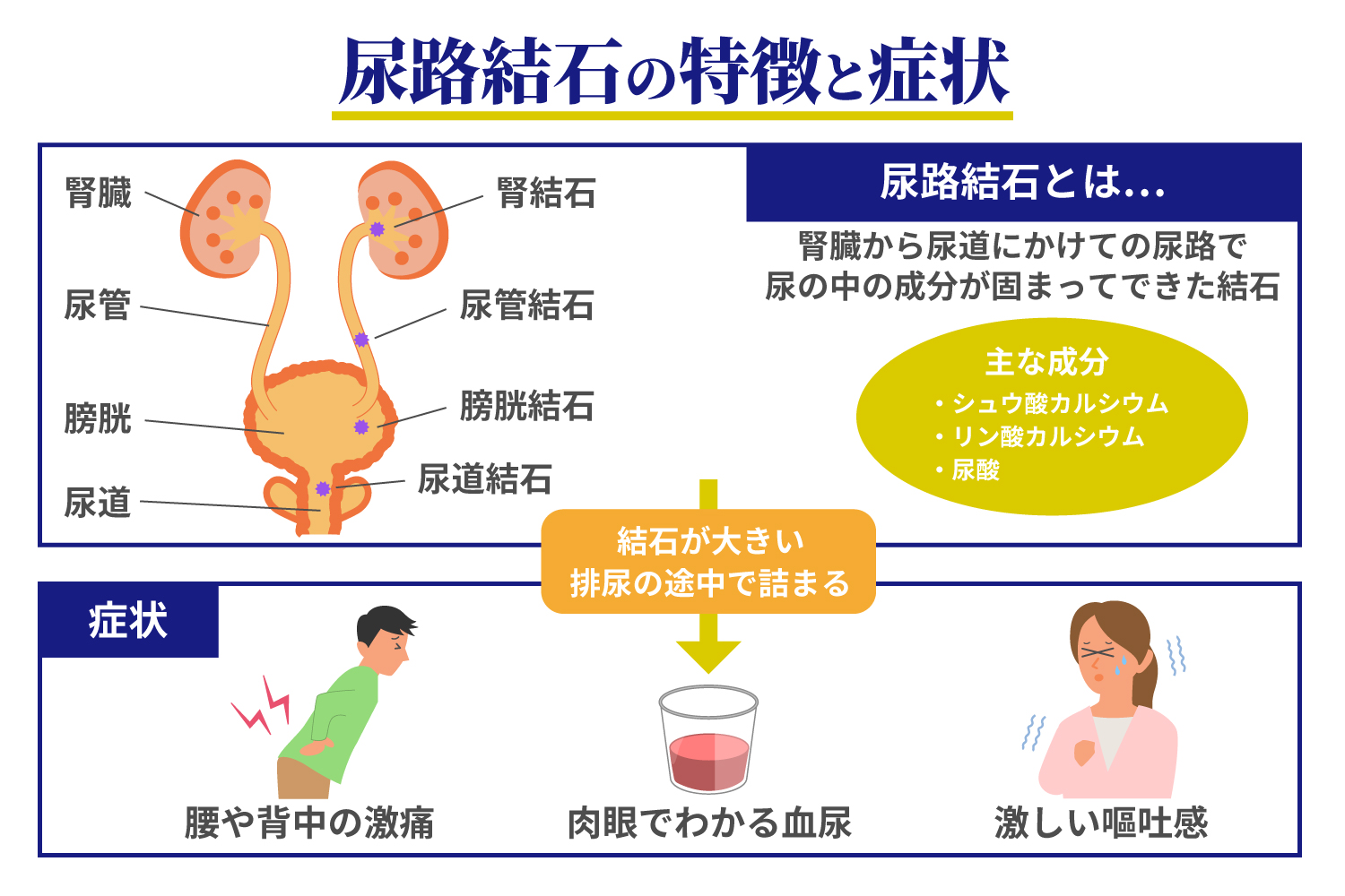 膀胱結石の初期症状と痛みのサイン｜排尿痛・血尿の原因と最新治療法
