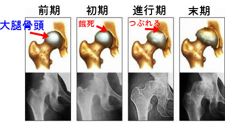 【最新】 大腿 骨頭 壊死 芸能人 ファン必見の最新情報 #603