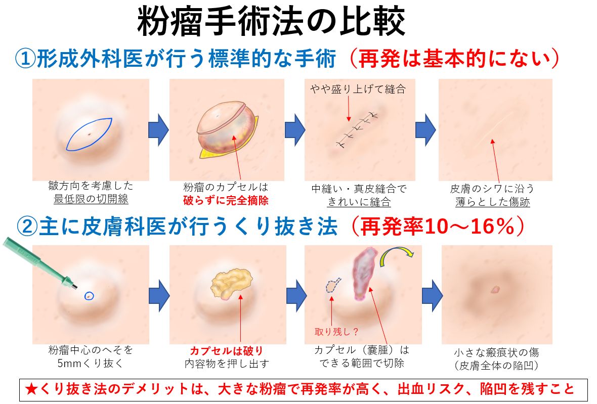 粉瘤の正しい治し方とは？自力で潰す危険性と2026年最新手術費用