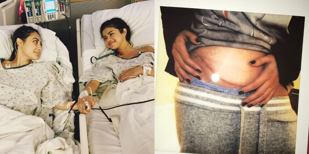 What Disease Does Selena Gomez Have