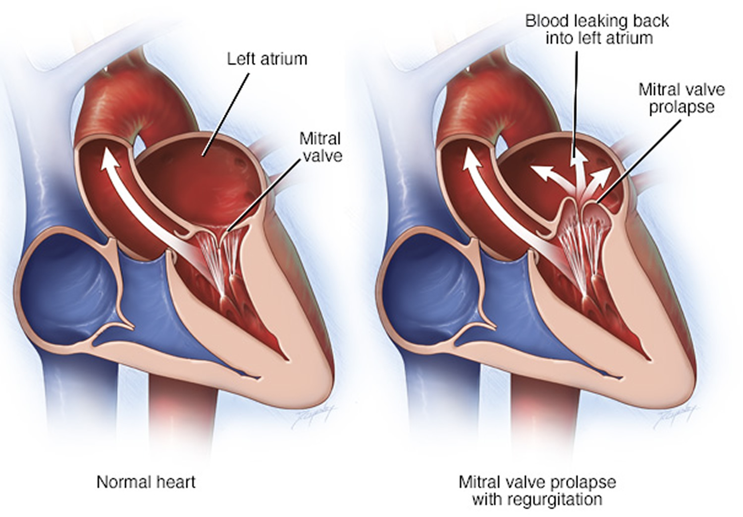 Mitral Valve Prolapse Symptoms