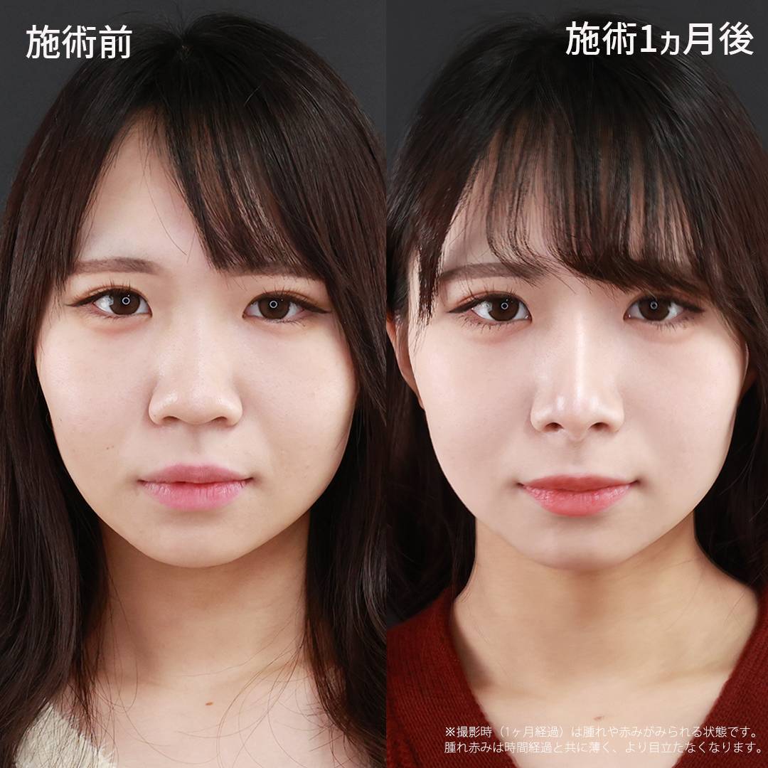 鼻整形ビフォーアフターの真実｜後悔しないための2026年最新ガイド