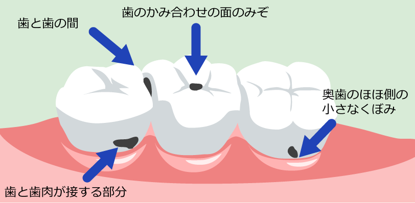虫歯は自力で治せる？削らない初期ケアと放置Ngの境界線を徹底検証