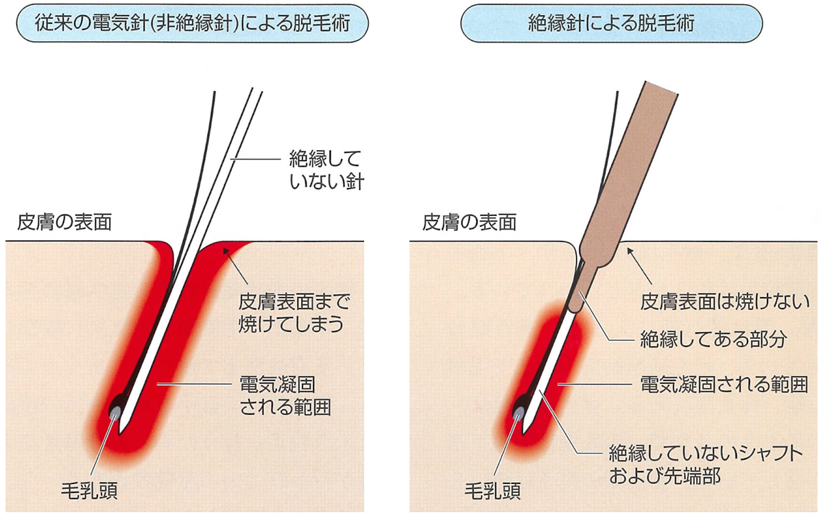 ニードル脱毛とは？白髪や眉毛も即日永久脱毛できる仕組みと痛みの真相