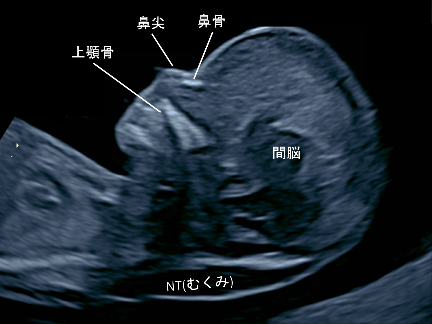 胎児の首のむくみとダウン症の真相｜Nt基準値や消える理由を解説