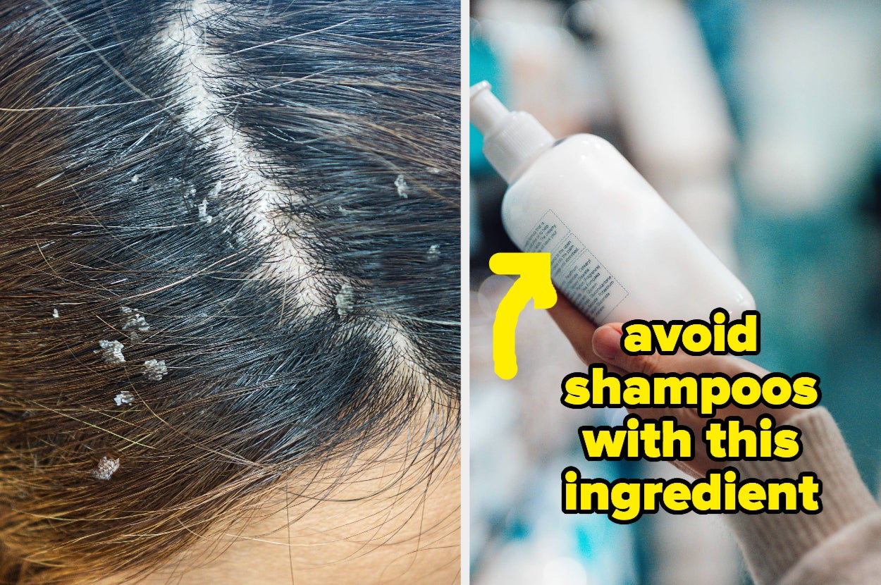 How to Treat Very Dry Scalp