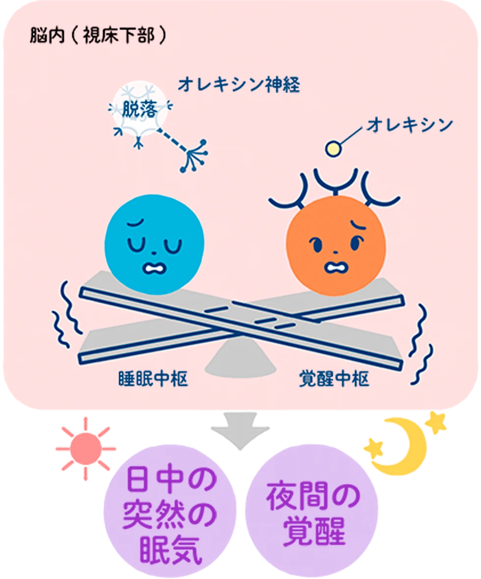 ナルコレプシーとは？猛烈な眠気と脱力発作の正体・診断や最新治療法