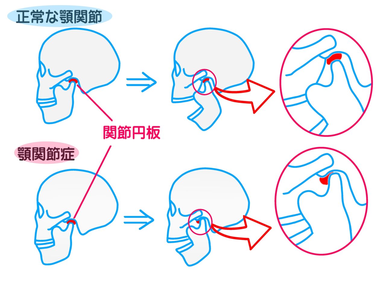 片方の顎関節が痛いのはなぜ？口が開かない原因と2026年最新の解決策