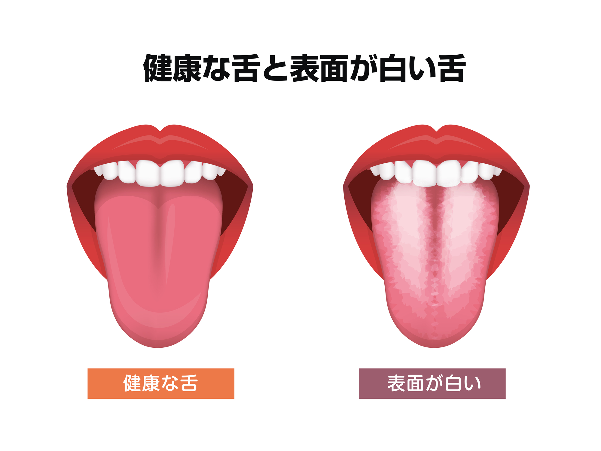 舌の奥が白い原因は？無理に取れない正体と口臭・病気のリスク検証