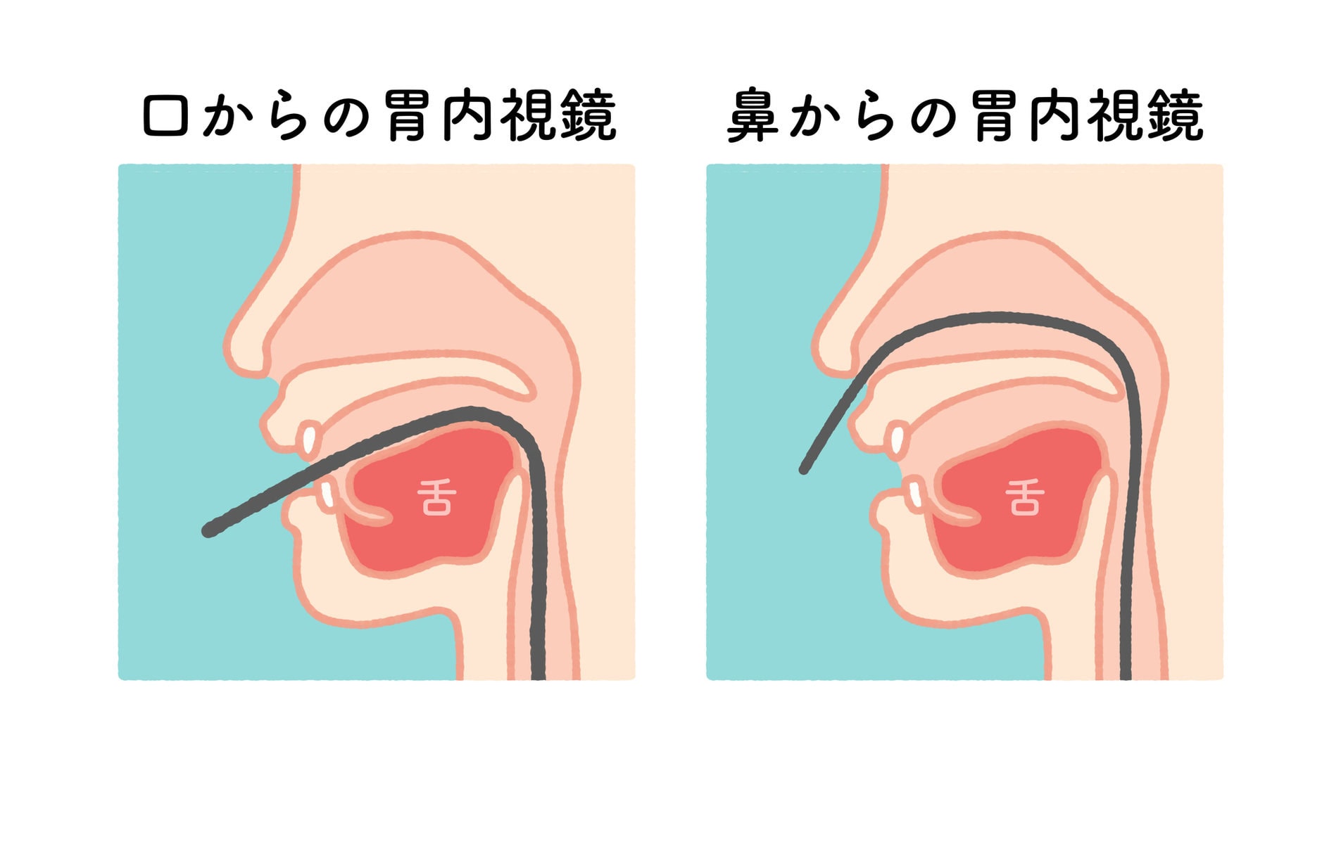 胃カメラは口と鼻どっちが楽？痛みの真相と後悔しない選び方