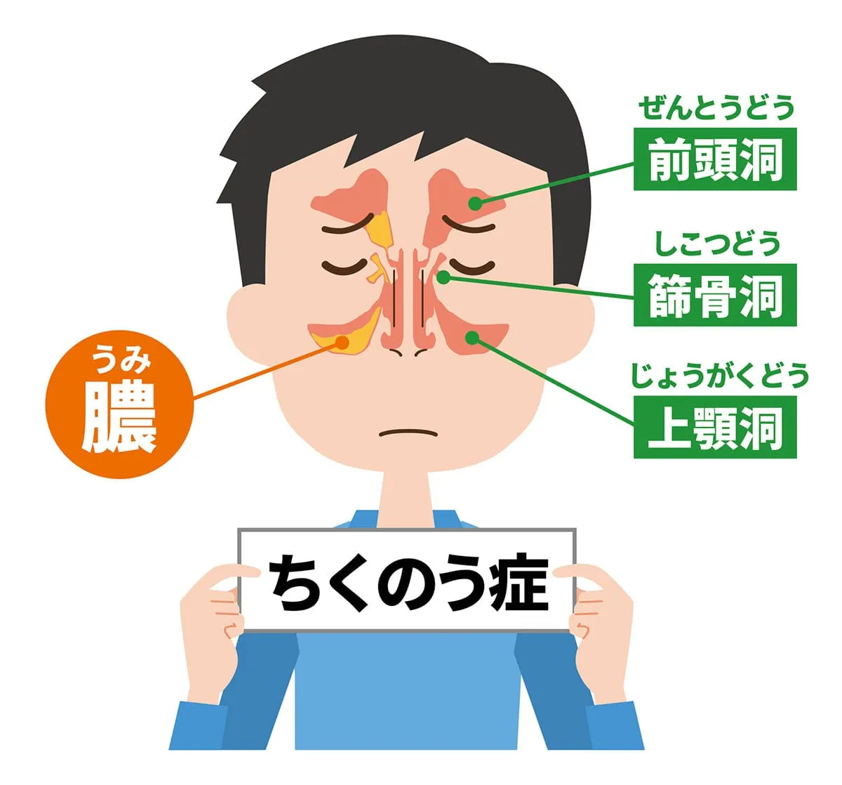花粉症で頭が痛い原因は？副鼻腔炎や酸欠の真相と即効治し方まとめ