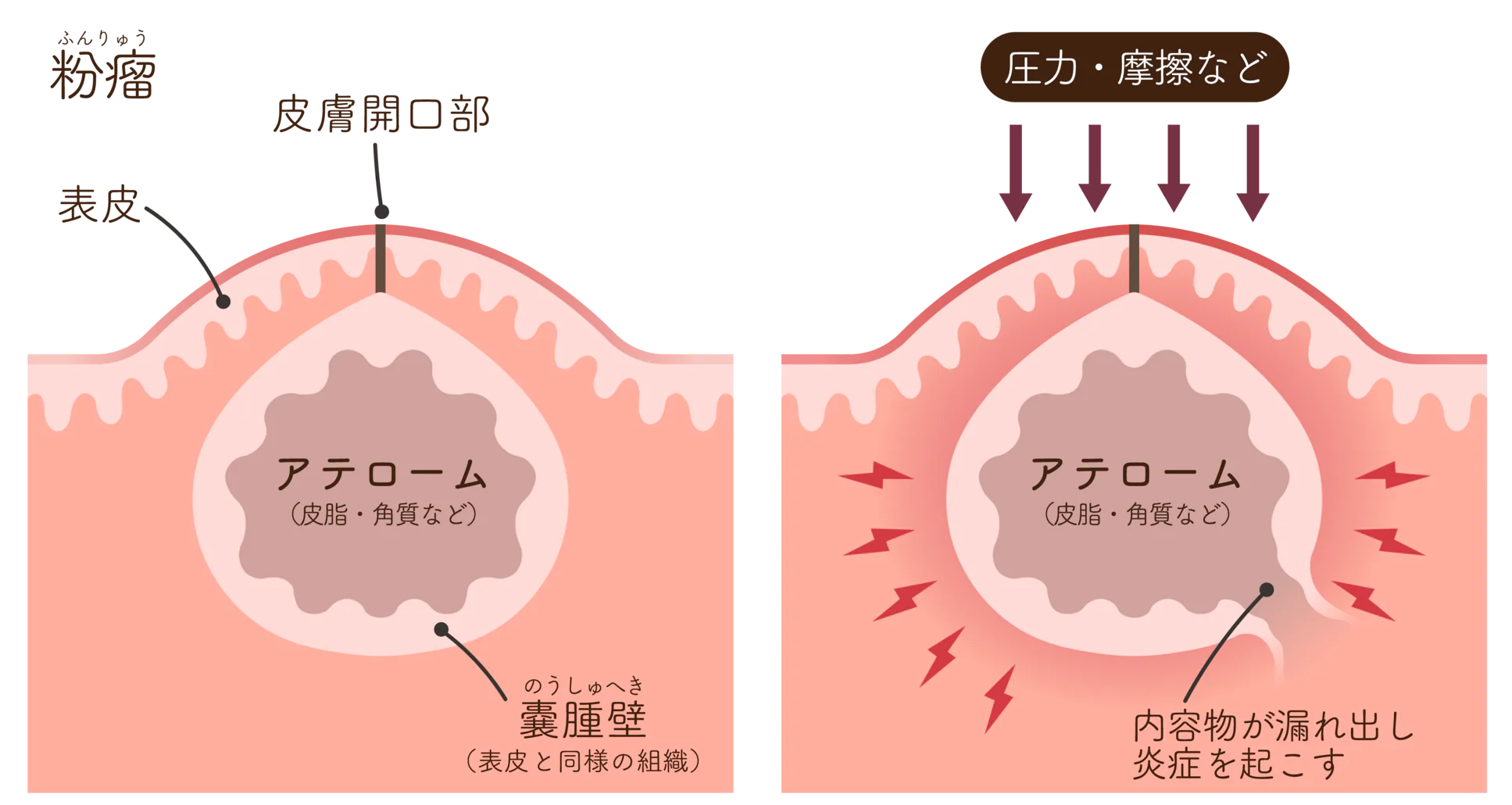 粉瘤の本当の原因とは？不潔説の嘘と絶対に潰してはいけない理由