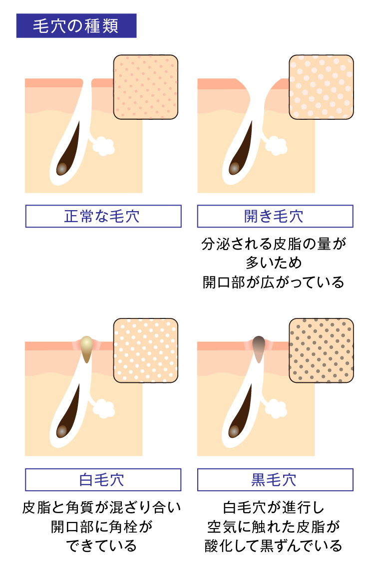 顔の毛穴が目立つ原因とは？良かれと思ったNgケアと2026年解決策