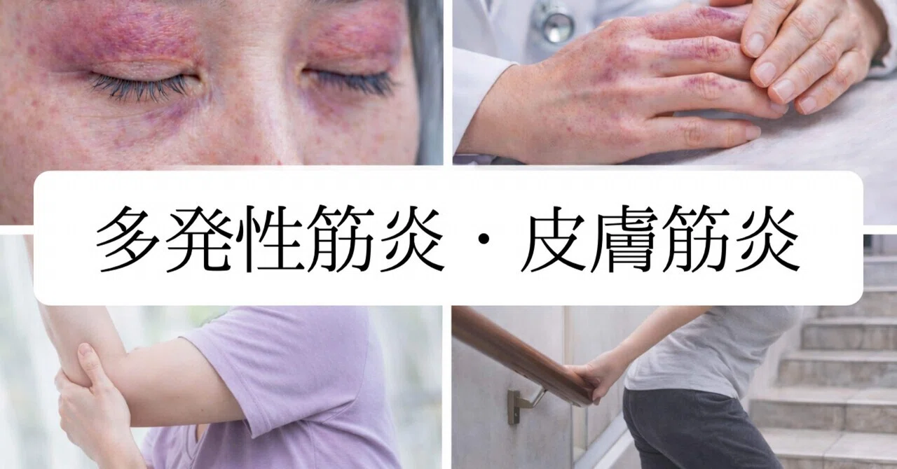 膠原病・皮膚筋炎の初期症状と予後｜寿命の真相と2026年最新治療