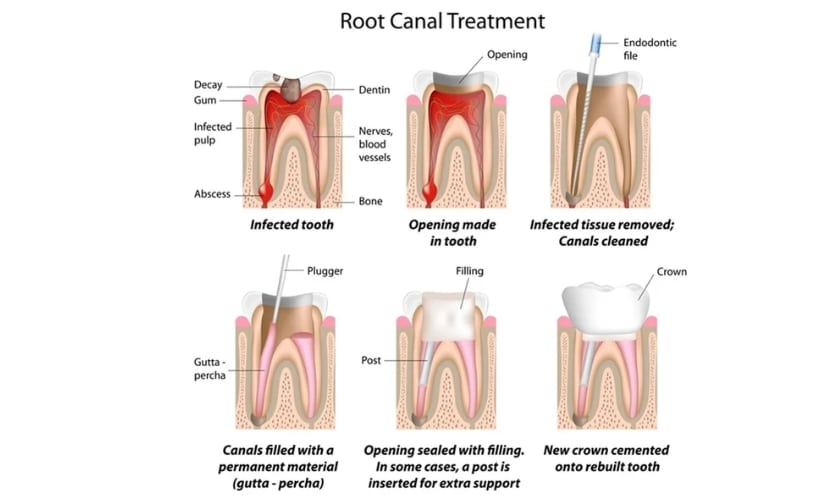 How Long Is the Pain After Root Canal