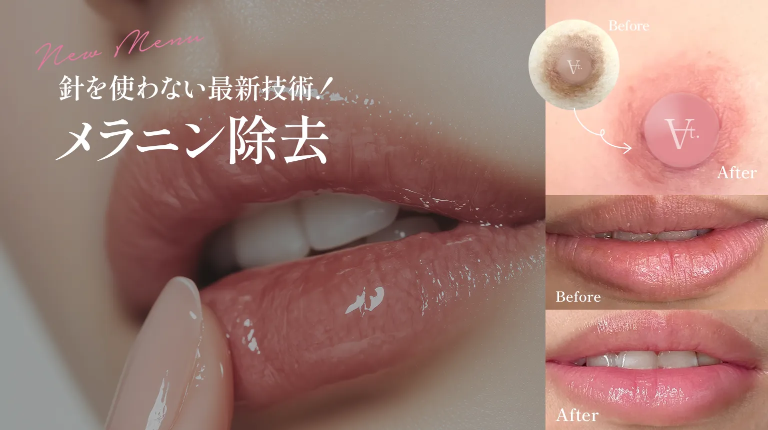 乳首をピンクにする方法は？黒ずみの原因と皮膚科レーザー治療の真相