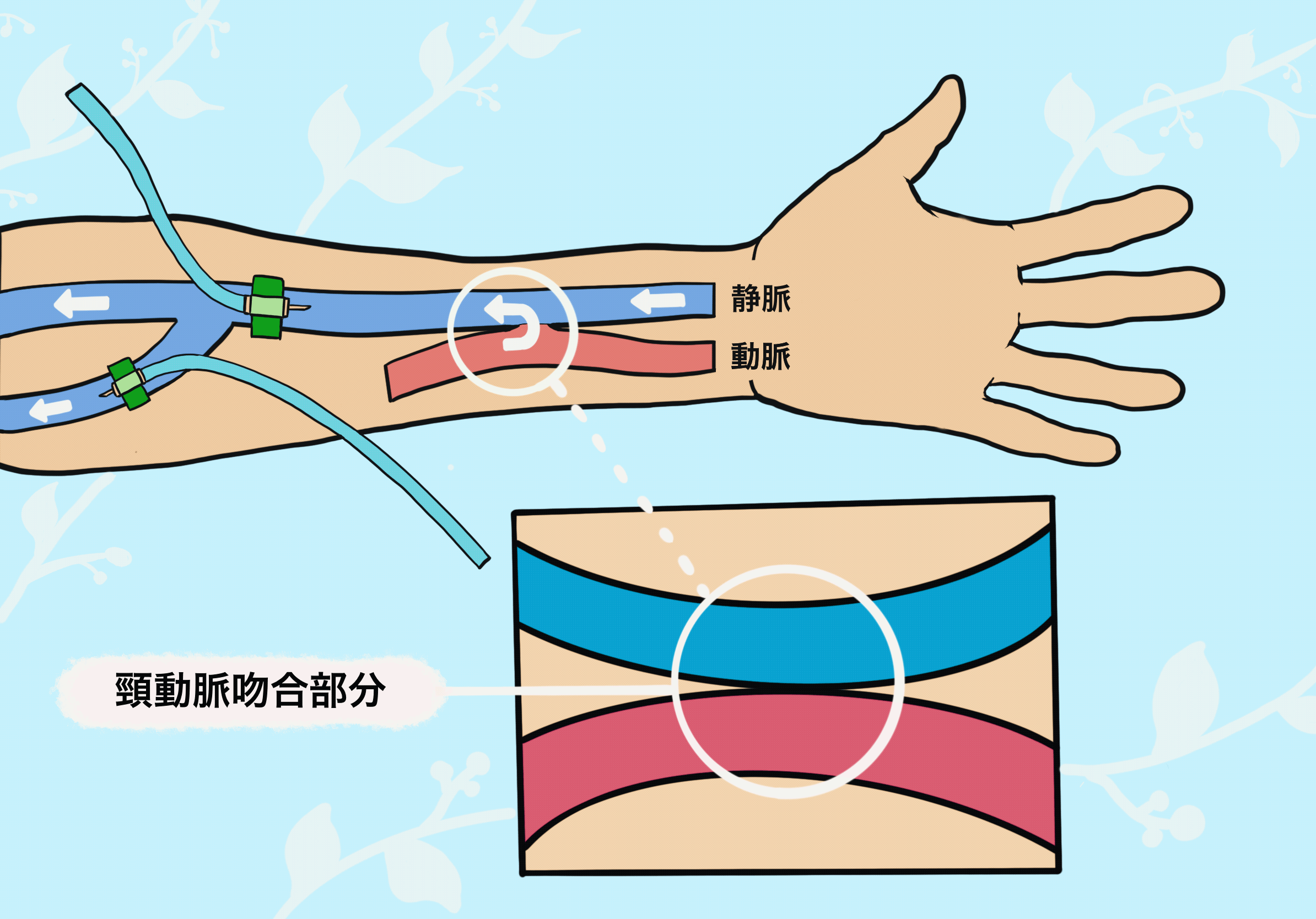シャントとは？透析に必要な仕組みから手術・寿命と注意点まで徹底解説