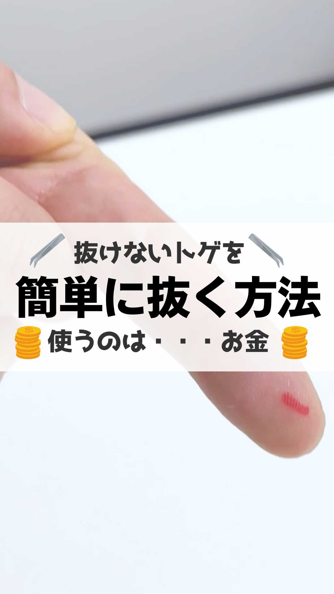 指のトゲが取れない焦りを解消！痛くない裏ワザと病院受診の危険ライン