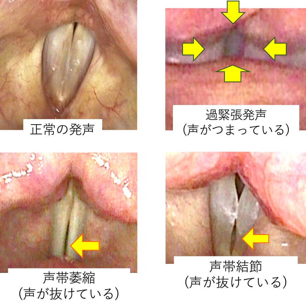 声が出ない…偽膜性声帯炎とは？原因や完治までの治療期間・予防法を解説