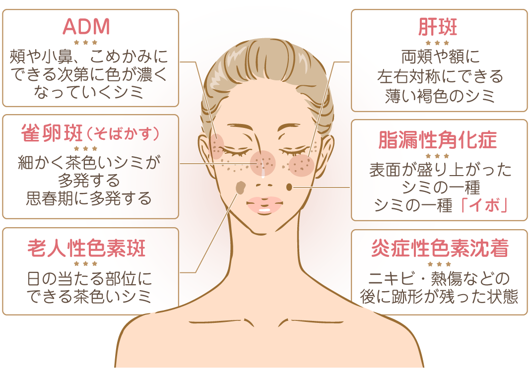 脂漏性角化症の原因とは？急増するイボの真相と最新治療法を徹底検証