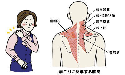「ただの肩こり」と見過ごすな。命を奪う心筋梗塞のサイン、その「肩の痛み」の正体とは？