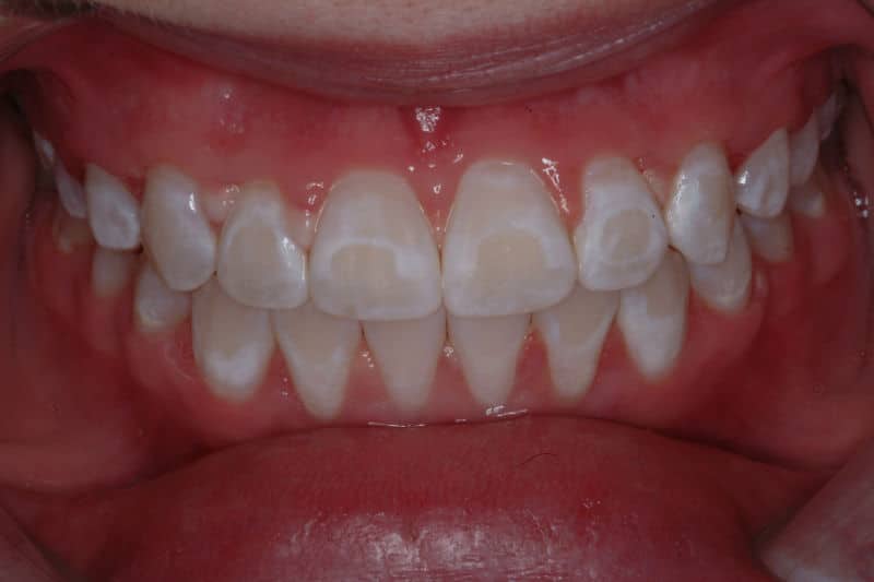 White Spots on Teeth After Whitening