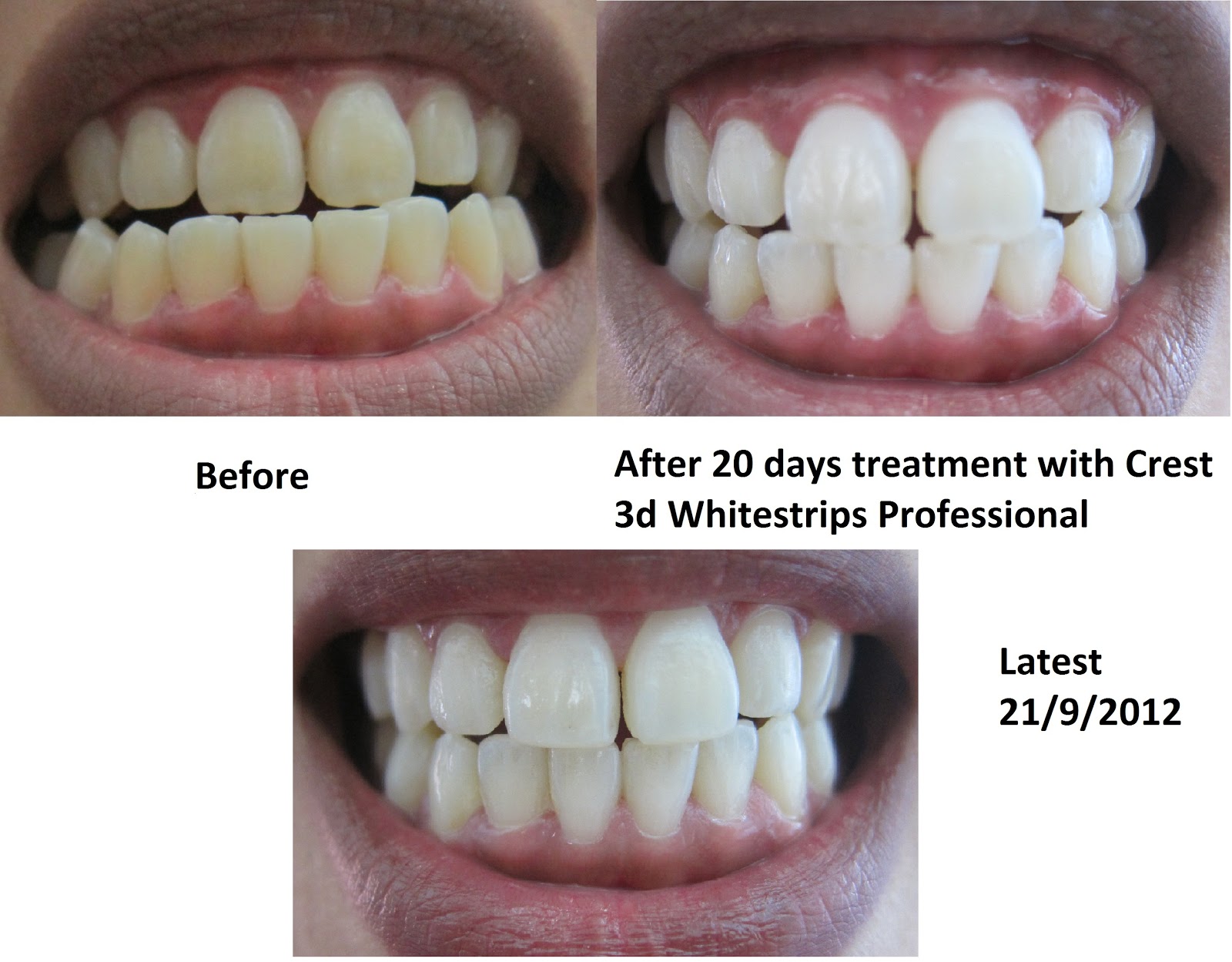 Crest Whitening Strips Before and After