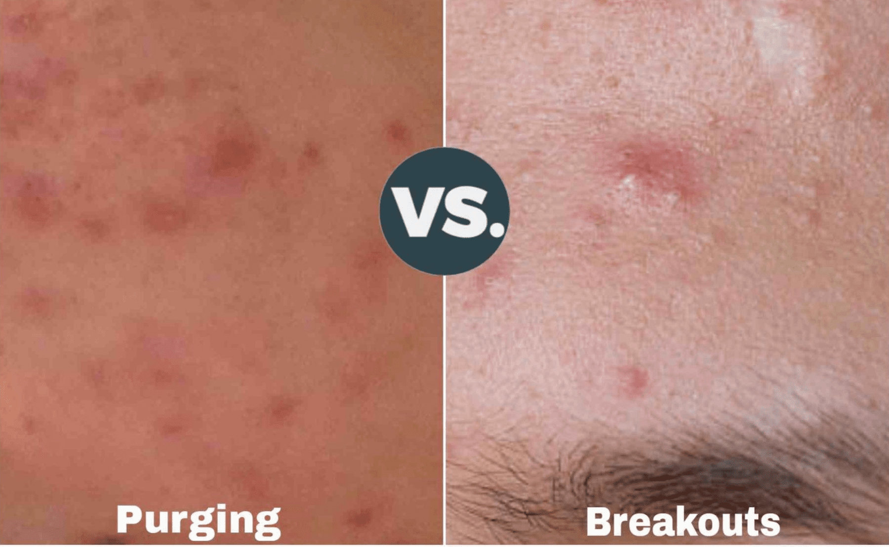 What Is the Tretinoin Purge