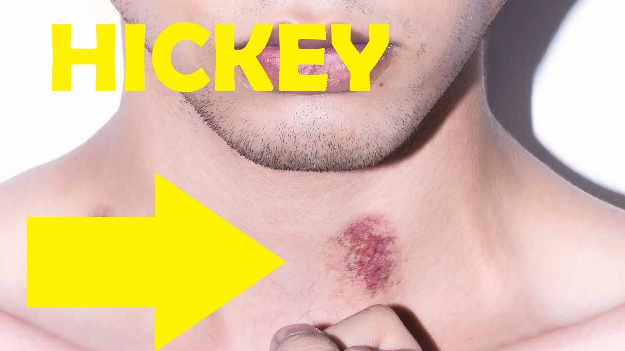 What Are Hickeys on Neck