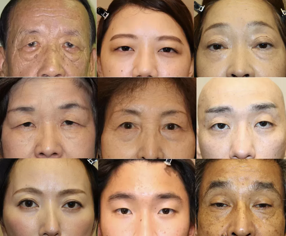 まぶたが下がる原因は病気？片目だけ重い時の見分け方とセルフチェック