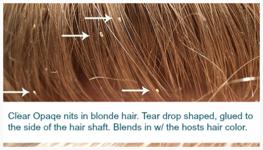 Pictures of Lice Nits in Blonde Hair