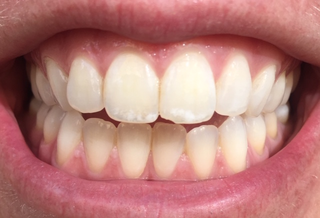 White Specks on Teeth After Whitening