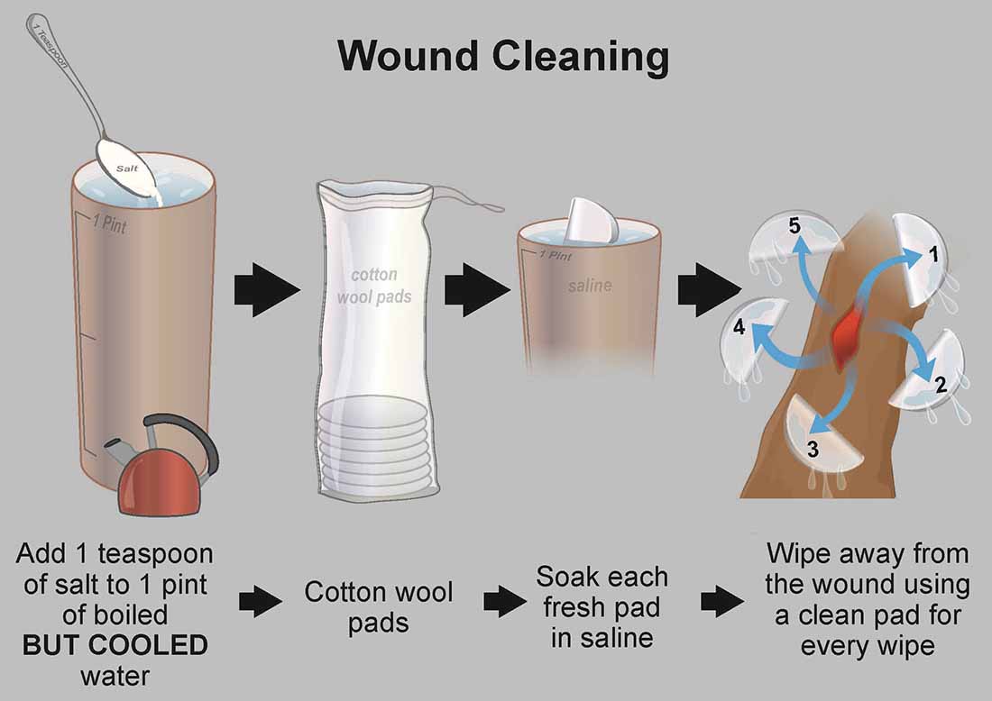 What Is Used to Clean Wounds
