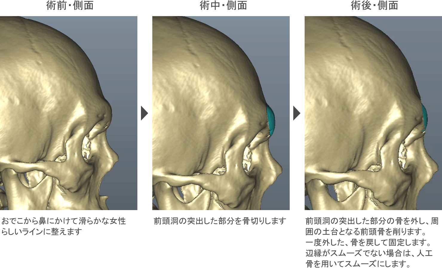 【2026年骨格トレンド】「眉 骨 出 てる」悩みは過去のもの？立体顔ブームが生んだ最新メイク術と美容医療の最前線
