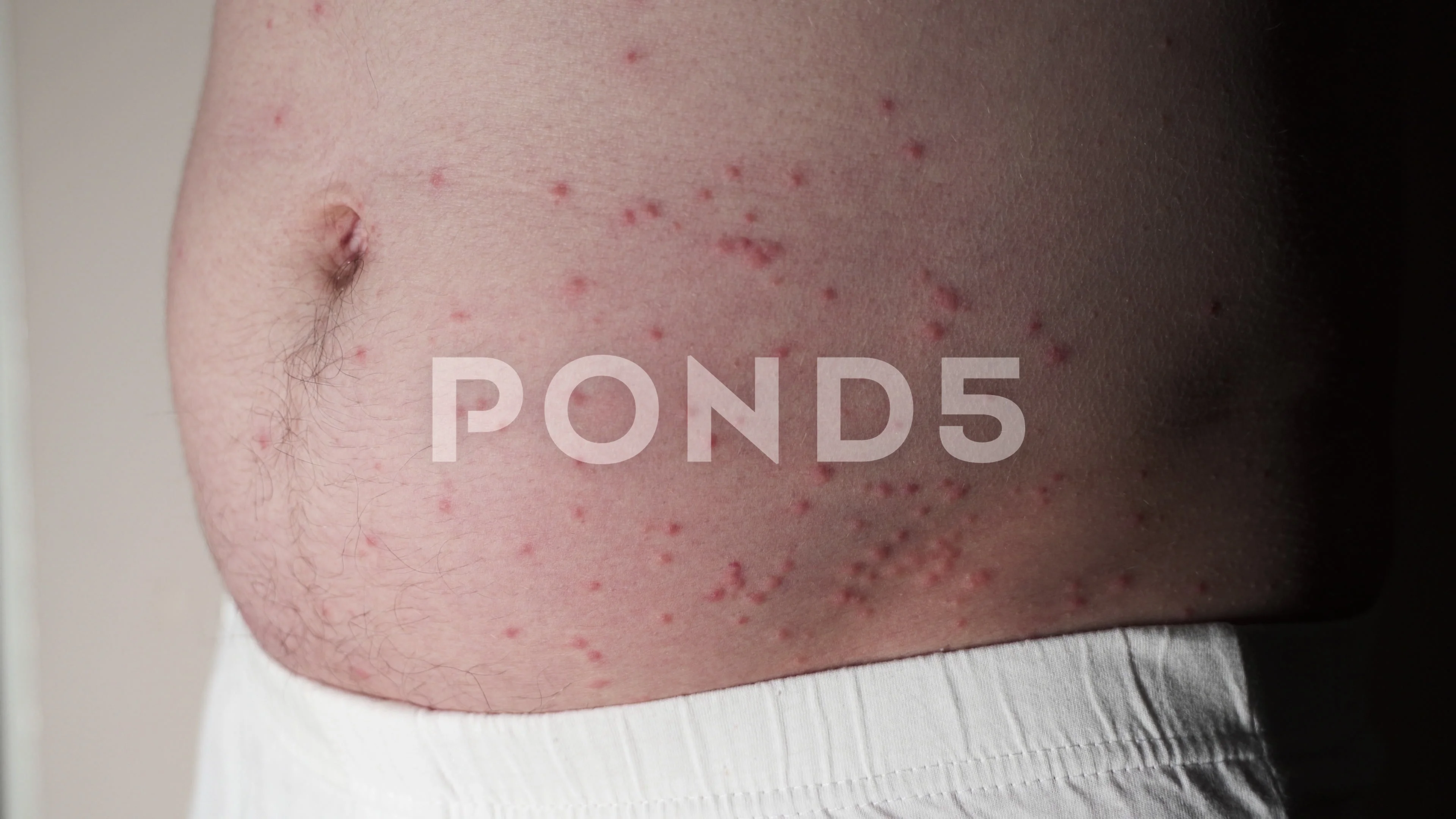 Red Bumps on Abdomen Not Itchy