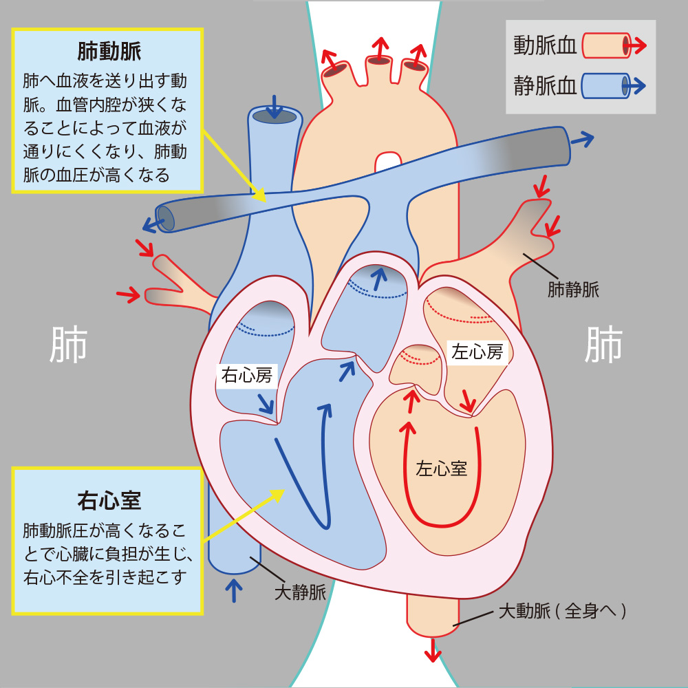 ギラン・バレー症候群の初期症状と原因｜手足のしびれから治る確率まで徹底解説