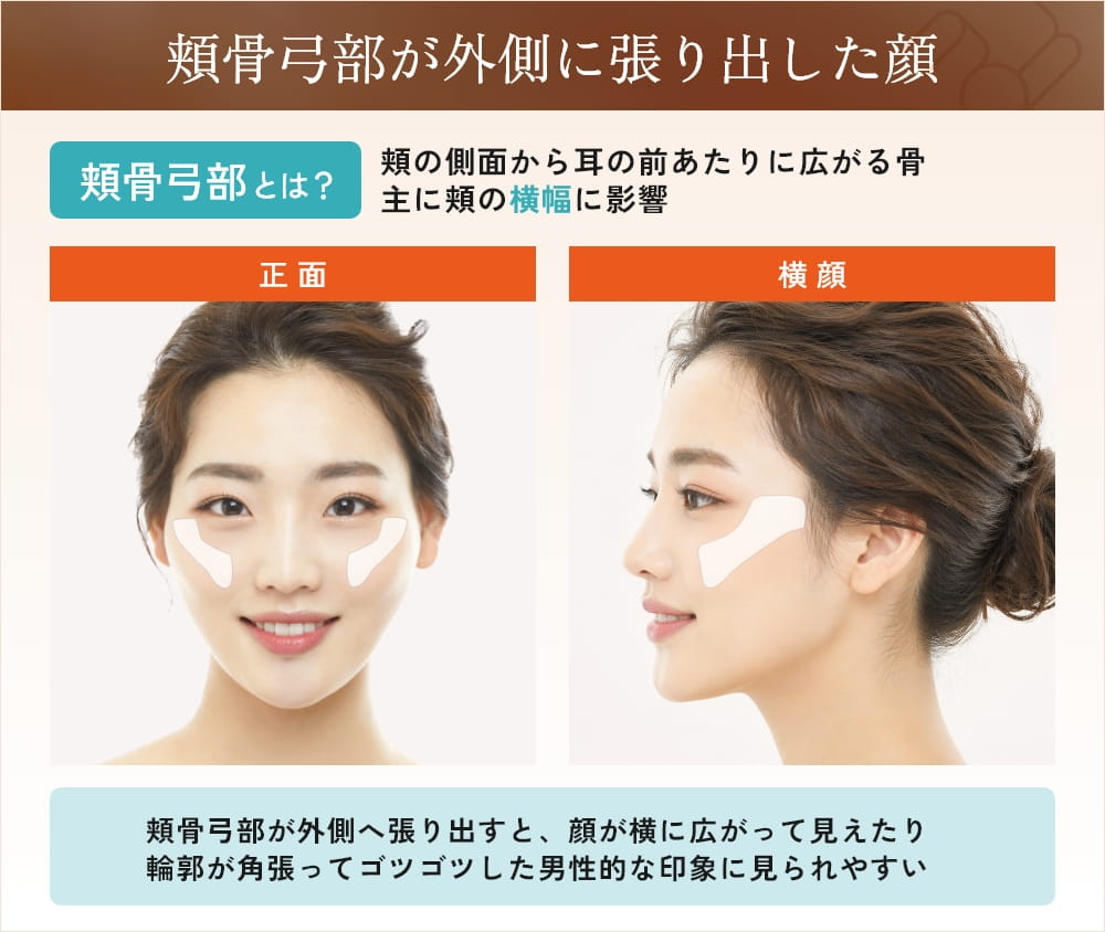 頬骨が横に出てる原因は骨格だけ？自力改善と輪郭整形の真実【2026年最新】