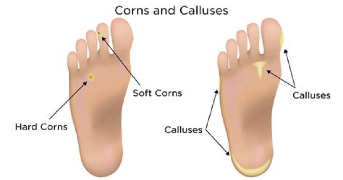Does Corn Give You